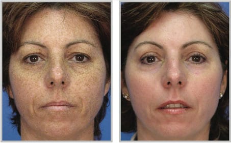 Before and After. Five months post 1 tx | courtesy of Jason Pozner, MD, FACS
