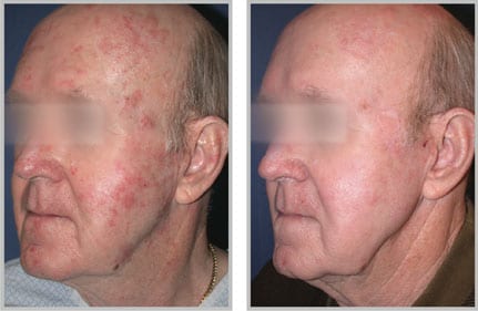 Before and After. Three weeks post 2 tx | courtesy of R. James Koch, MD