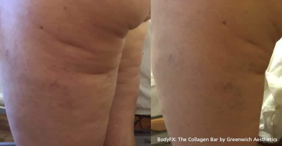 GA_contoura Contoura Before and After Austin TX | Cellulite Reduction