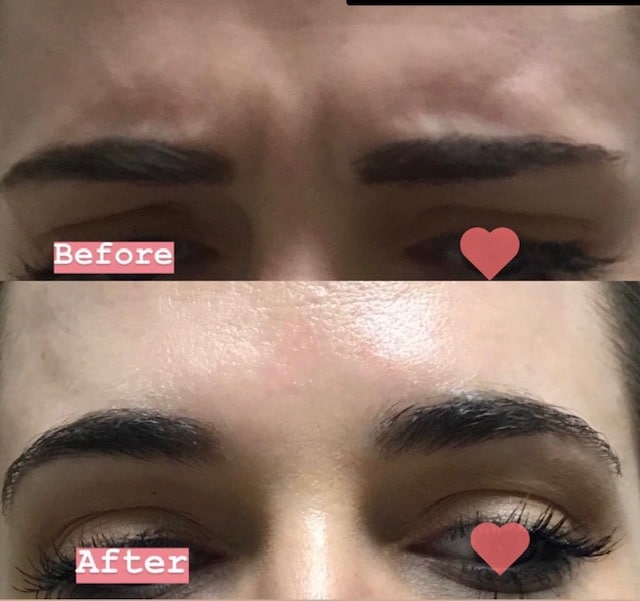patient's forehead before and after botox cosmetic, smoother after treatment