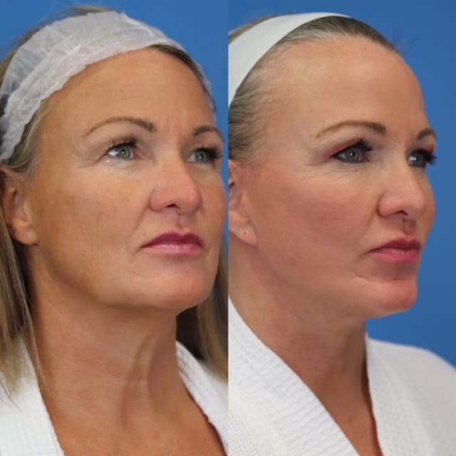 Before and After Surgical Face and Necklift-Atencio