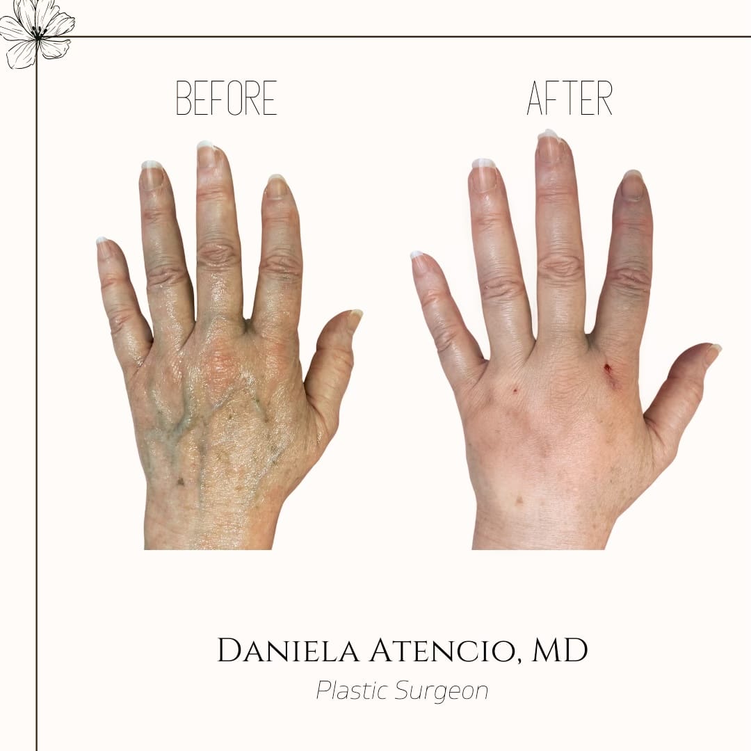 Before and after hand filler with Radiesse-Atencio