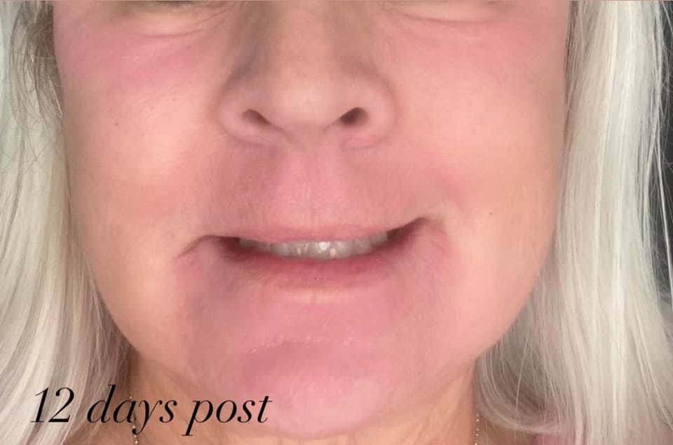 after-laser resurfacing by Courtney Grant