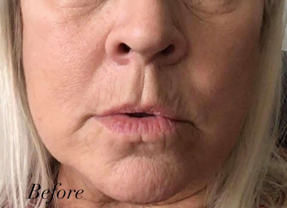 before-laser resurfacing by Courtney Grant