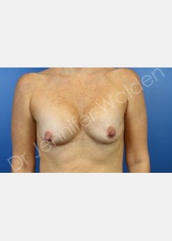 secondary breast surgery