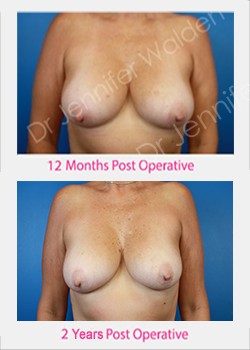 BREAST AUGMENTATION WITH FAT TRANSFER (NO IMPLANTS)