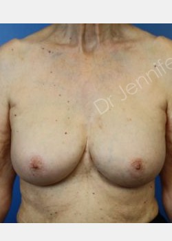 Bilateral Breast Implant Exchange and Pocket Conversion, Suction Assisted Liposuction of Bilateral Axillae, Autologous Fat Transfer to Breasts