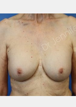 Bilateral Breast Implant Exchange and Pocket Conversion, Suction Assisted Liposuction of Bilateral Axillae, Autologous Fat Transfer to Breasts