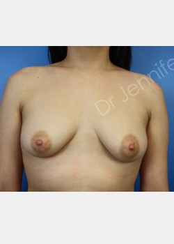 Breast Augmentation with Suction Assisted Lipectomy to Bilateral Axilla