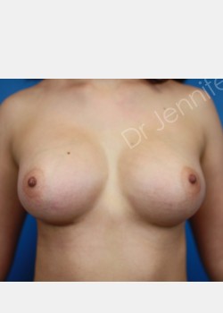 Secondary (revisional) Breast Surgery