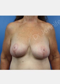 Breast Mastopexy