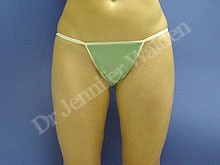 Power-Assisted Liposuction of Medial Thighs & Buttocks