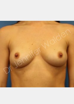 Breast Augmentation -silicone