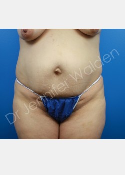Breast Augmentation with Lift & Abdominoplasty with Liposuction
