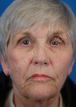 Facialplasty with Neck Lift, Laser Resurfacing, and Broad Band Light Laser to Bilateral Hands