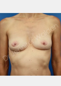 Breast Augmentation with Fat Transfer (No Implants)
