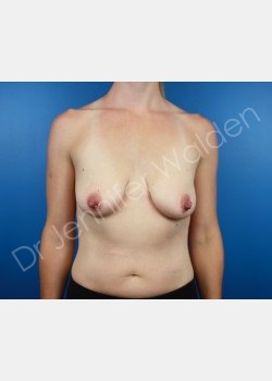 BREAST AUGMENTATION WITH LIFT