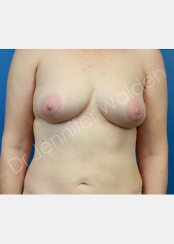 BREAST AUGMENTATION WITH FAT TRANSFER (NO IMPLANTS)