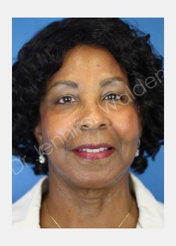 Facelift, Necklift with Lateral SMASectomy and Suction-Assisted Lipectomy of Neck