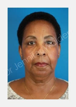 Facelift, Necklift with Lateral SMASectomy and Suction-Assisted Lipectomy of Neck